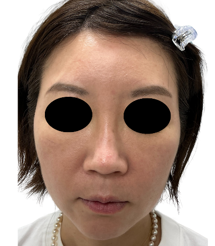 初回施術より3ヶ月