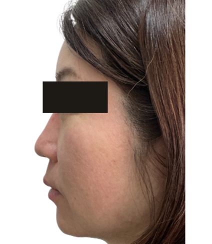 初回施術より3ヶ月