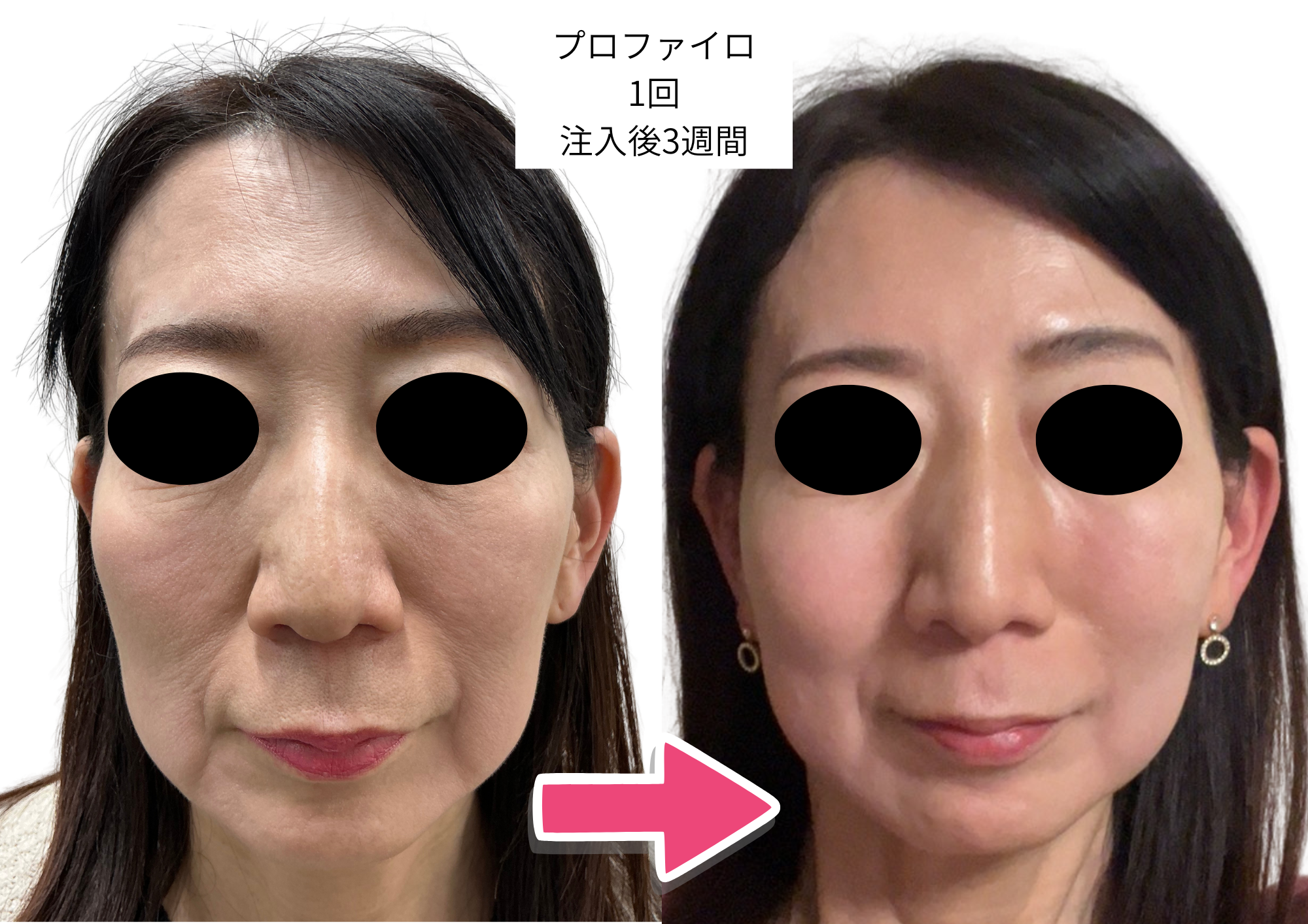 プロファイロ症例1