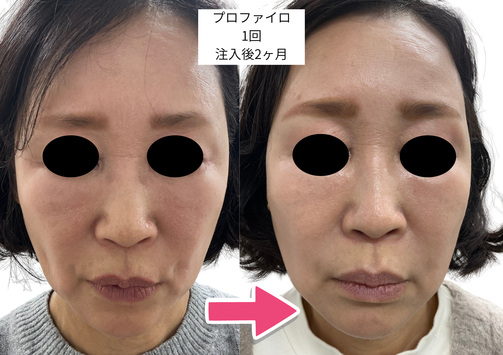 プロファイロ症例2