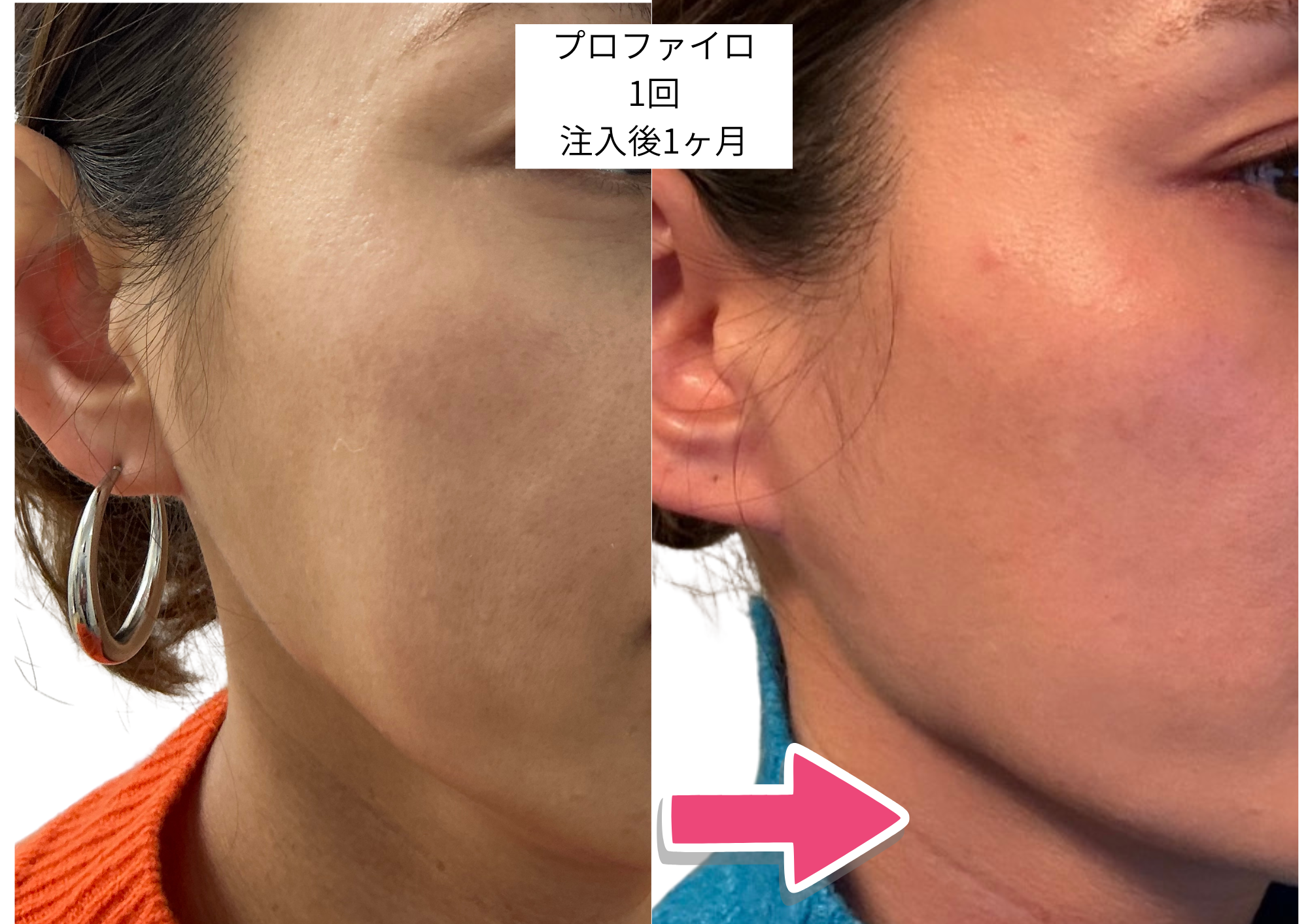 プロファイロ症例3