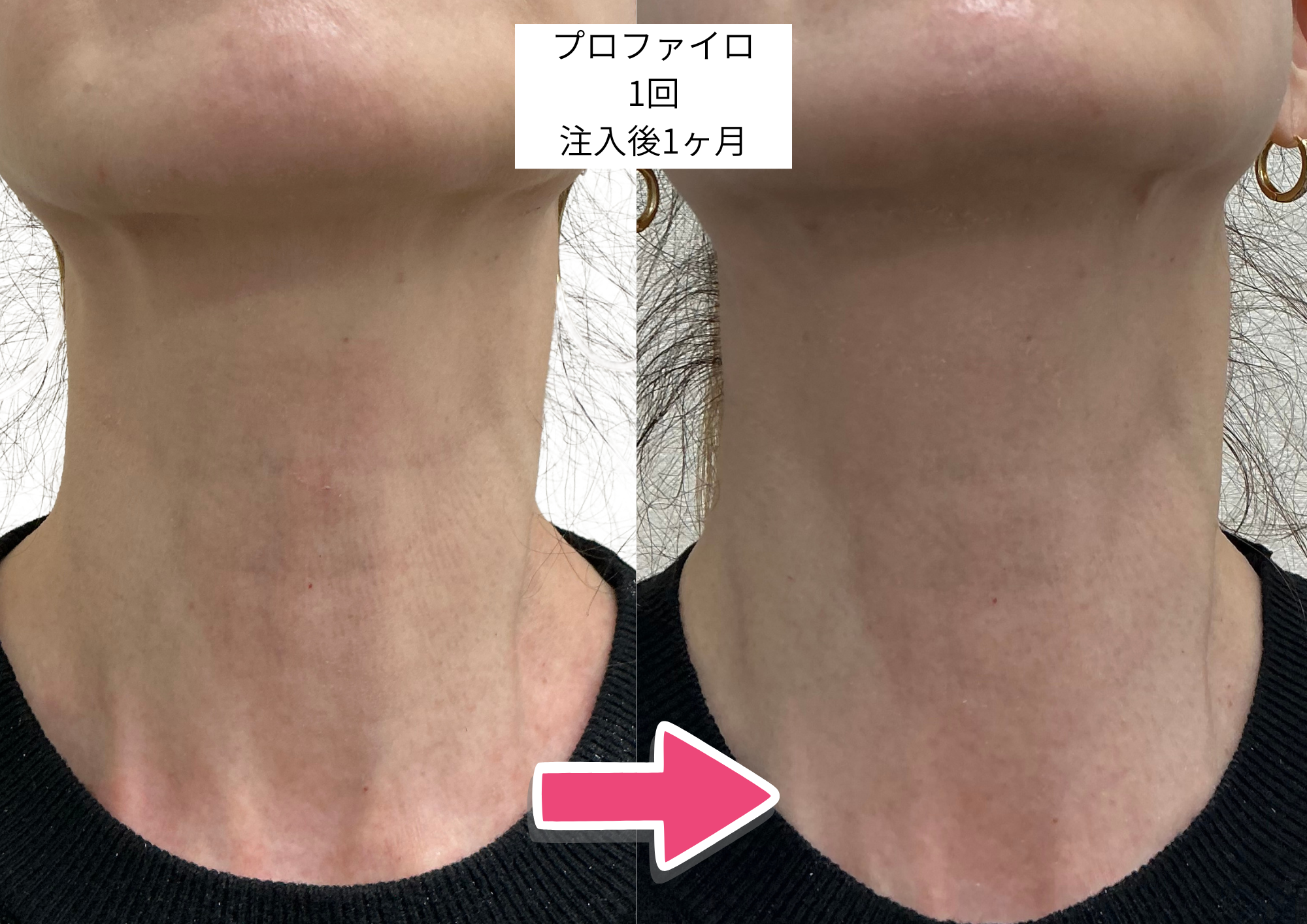 プロファイロ症例4