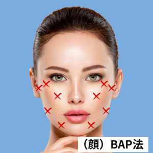 プロファイロBAP法 顔10カ所の注入ポイント｜バイオリモデリング治療で使用される注入部位