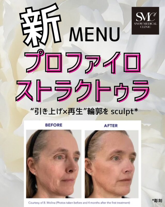 大人気メニューの#プロファイロ に加え、#プロファイロストラクトゥラ もラインナップに追加されました！

💧プロファイロ ストラクトゥラとは？
従来のヒアルロン酸とは異なり、肌の構造そのものを整える“再生注射”です。
高分子と低分子ヒアルロン酸を組み合わせ、ハリ・弾力・輪郭を自然にリフトアップ。
ドクターが浅い脂肪層に丁寧にカニュラ注入を行うことで、
肌の内側からふっくらと若々しい印象へ導きます。

💠おすすめ💠
・フェイスラインのゆるみ
・頬のこけ、疲れて見える印象
・ナチュラルな若返りを求める方に

🩵2回コース（約1か月間隔）での施術がおすすめです。

＊初回・半年以内継続価格　99000円
＊通常価格　121000円

#スノーメディカルクリニック #プロファイロストラクトゥラ #肌再生注射 #港区美容皮膚科 #再生医療 #ヒアルロン酸注射 #ナチュラルリフト #ツヤ肌

＊＊＊
モニター様の受け付けは終了しました